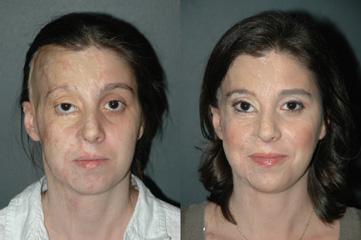 Before And After Image Facial Burns